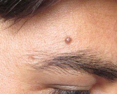 A mole above the right eyebrow