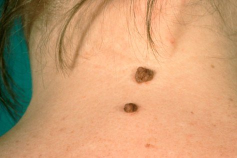 A mole on back of neck