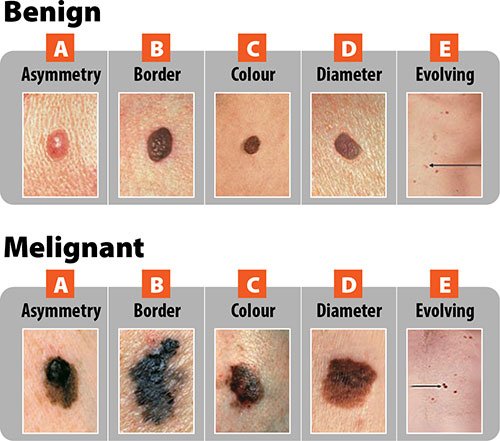 ABCDE chart for diagnosis of cancerous mole