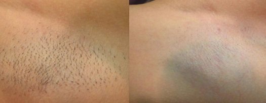 Before and after burn during laser hair removal