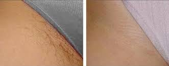 Bikini area laser hair removal before and after