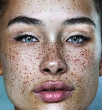Black freckles