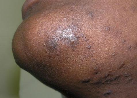 Bumps after Laser Hair Removal