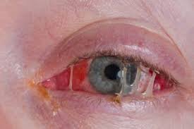 Causes of Bacterial Pinkeye or Conjunctivitis