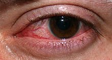Causes of Red Eye - Iritis