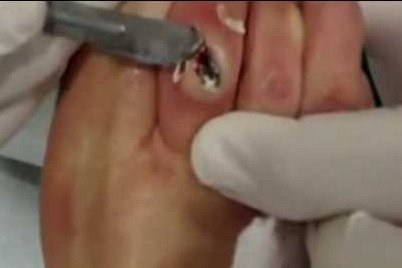 Corn removal by surgery