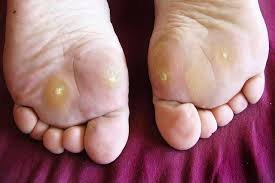 Corns on sole of foot