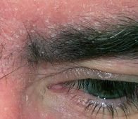 Eyebrow Dandruff