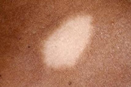 Laser hair removal patch