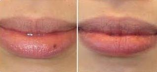 Mole removal cream - before and after
