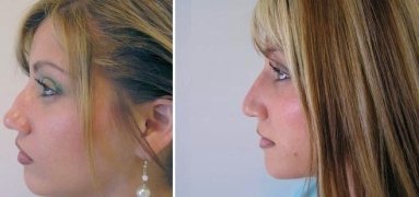 Nose Bridge – Piercing, Sore, Painful & Surgery- Bump on Nose Bridge