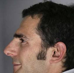 Nose Bridge – Piercing, Sore, Painful & Surgery- Very High Nose Bridge