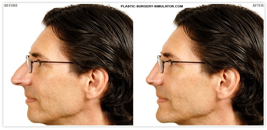 Nose Job Simulator or Virtula Nose Job
