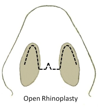 Open Rhinoplasty Procedure