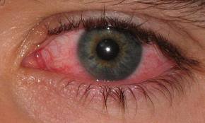 Pink Eye Remedies – Natural and Home Remedies for Pinkeye or Conjunctivitis