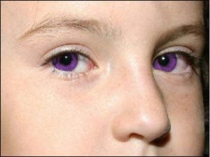 Purple Eyes – Causes, Purple Eye Disease and Makeup Tips