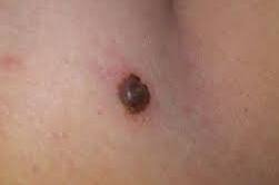 Raised Mole on Back