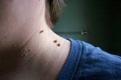Mole on kneck