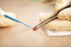 Raised mole removal by surgery