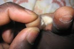 Soft corns between toes