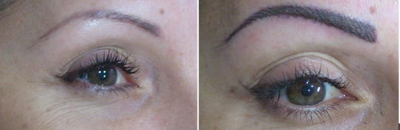 SoftTap® Technique (SoftTap permanent makeup)