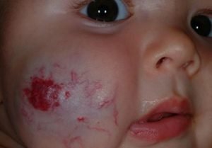 Strawberry birthmark on cheek