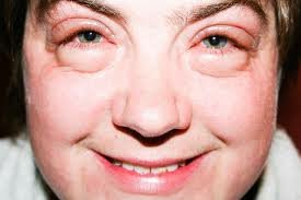 Symptoms of Puffy Eyes