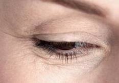 Under Eye Wrinkles - Crow's Feet and Fine Lines