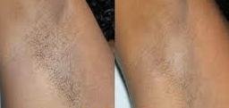 Under arm laser hair removal before and after one treatment