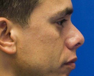 Upturned Nose After Rhinoplasty