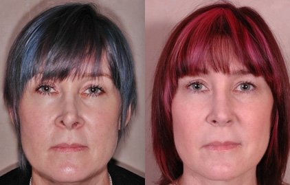 Upturned Nose – Rhinoplasty Before eand After
