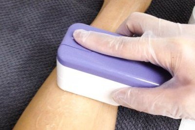 Use of IPL Hair Removal Home Kit