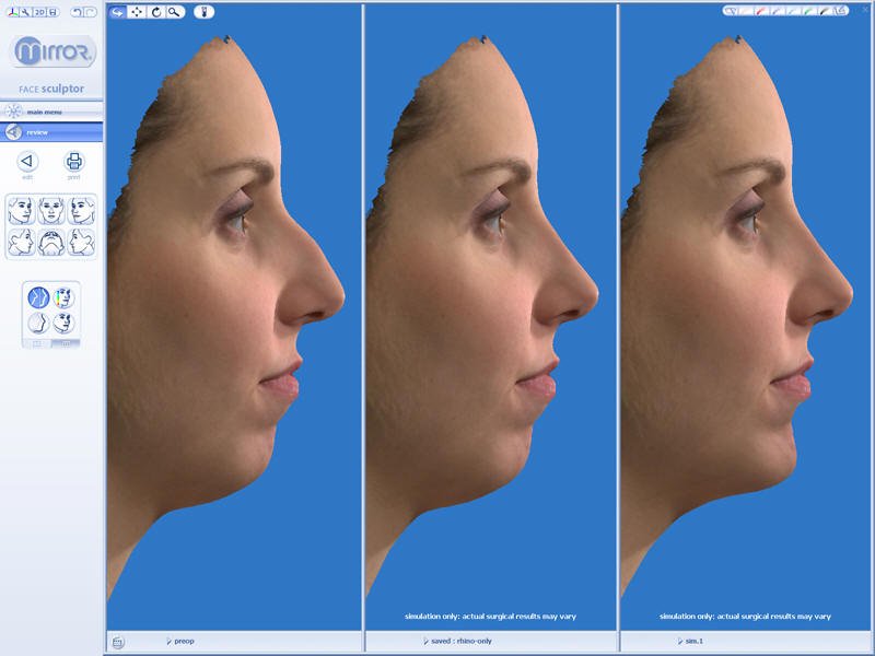 Virtual Nose Surgery