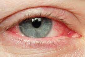 What is Viral Pinkeye or Conjunctivitis