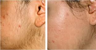 Before and after laser hair removal from face