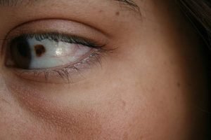 Birthmark on eye