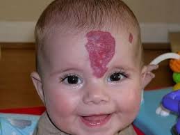 birthmark on forehead meaning