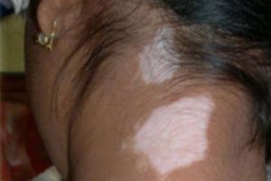 birthmark on neck meaning