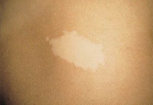 White birthmark on body