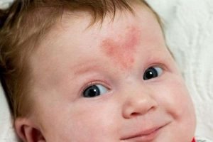 Heart-shaped birthmark on a baby's forehead
