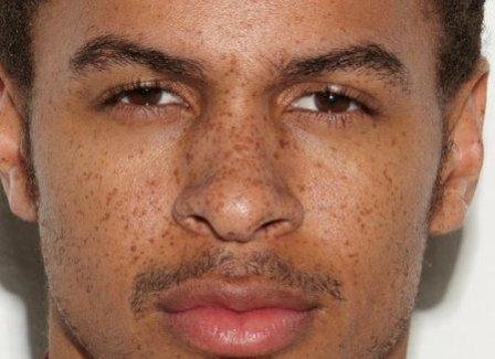 Black man with freckles