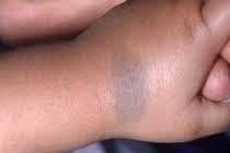Blue-gray mongolian birthmark on the hand