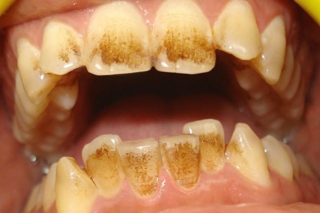 Teeth stains due to coffee
