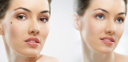 Complete excision of a mole on face - before and after