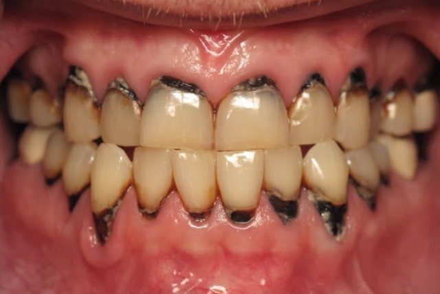 Teeth stains due to decay