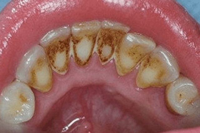 Extrinsic teeth stains
