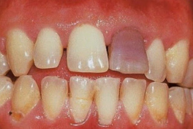 Intrinsic teeth stains