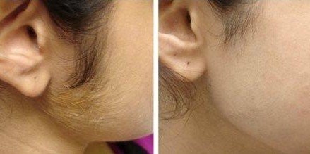laser hair removal from face before and after