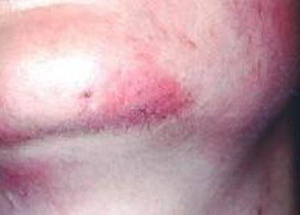 Redness after laser hair removal