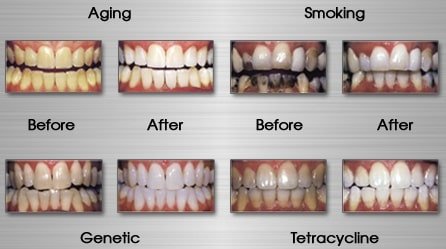Teeth stains removal and treatment